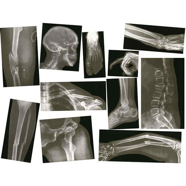 Broken Bones X-Rays, Biology/Life Science: Educational Innovations, Inc.